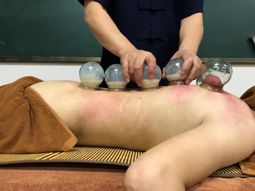 中醫(yī)可以通過拔罐辨別體質